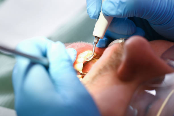Best Emergency Treatment for Dental Infections or Abscesses in Stratmoor, CO